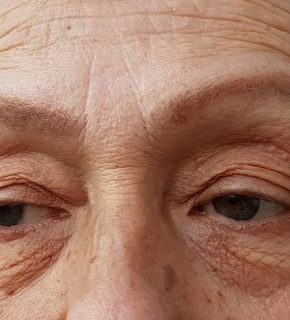 blefaroplastia